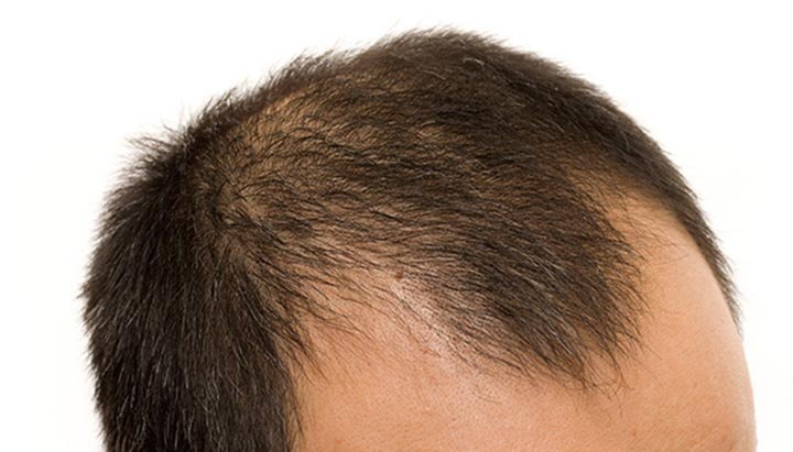 Androgenetic Alopecia