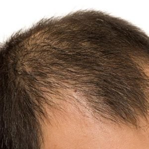 Androgenetic Alopecia