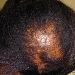 Chemical Alopecia