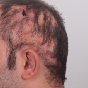 Scarring Alopecia