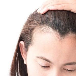 Traction Alopecia