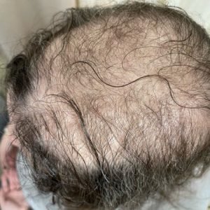 Trichotillomania